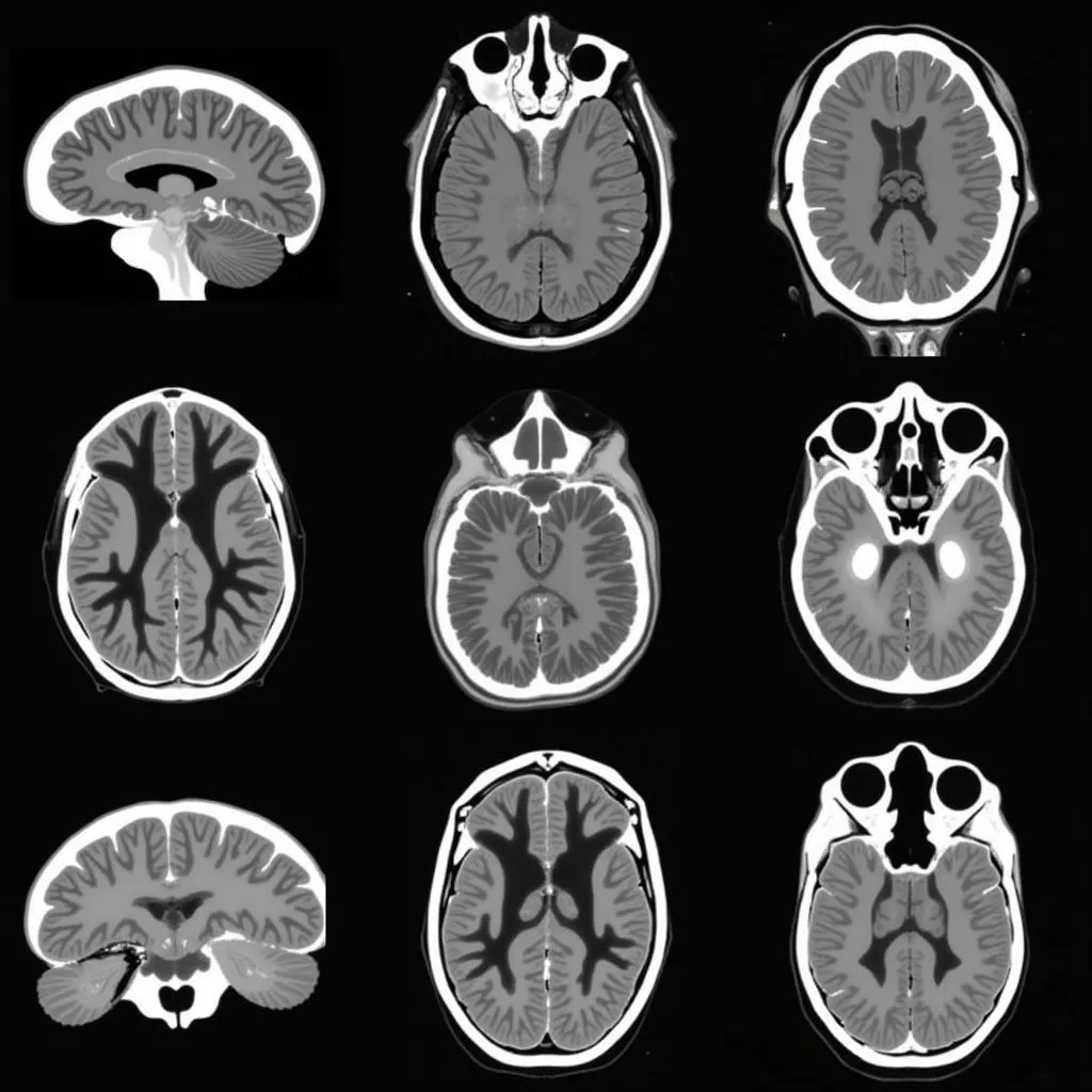 Hình ảnh minh họa các bệnh lý được chẩn đoán bằng phương pháp chụp cắt lớp não